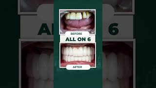 All On 6 The Perfect Lifetime Solution for Missing Teeth [upl. by Oys]