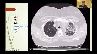 Reticular opacities part 3 Arabic version [upl. by Malchy]