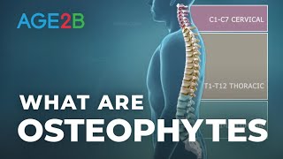 What Are Osteophytes  Spinal Bone Spurs  Anatomy  Degenerative Disc Disease [upl. by Jarv]