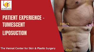 Patient Experience  Tumescent Liposuction at Venkat Center [upl. by Rosmunda300]