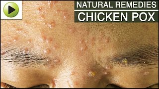 Skin Care  Chicken Pox  Natural Ayurvedic Home Remedies [upl. by Bourn]