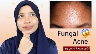 Everything You Need To Know About Fungal Acne [upl. by Kcirderf]