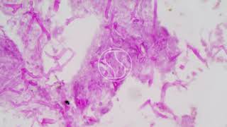 Mucormycosis under the microscope with Haematoxylin and Eosin HampE stain [upl. by Rudie]