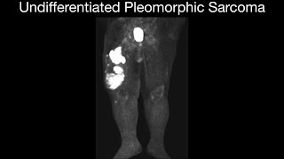 High Grade Undifferentiated Pleomorphic Sarcoma [upl. by Alexi]