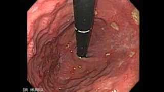 Endoscopy of Multiple Ulcers of the Stomach [upl. by Brendon908]