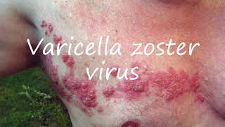 How to Pronounce Varicella zoster virus [upl. by Acinet144]