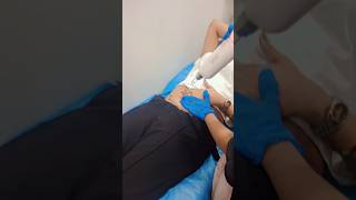 Pico Laser Treatment pico laserhairremoval whitening fullbodywhiteningtreatmentathome [upl. by Jacky379]