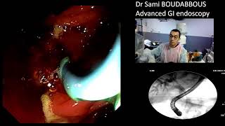 ERCP for pancreatic cancer [upl. by Nylac]