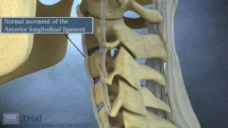 Anterior Subluxation in the Cervical Spine  3D Animation [upl. by Atthia470]