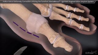 Hallux Varus Deformity Correction Utilizing the Forefoot InternalBrace™ Ligament Augmentation Implan [upl. by Dorita807]