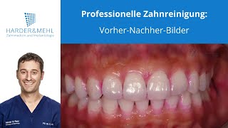 Professionelle Zahnreinigung VorherNachherBilder [upl. by Bail]