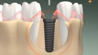 Zahnimplantation in 3D  Dental Implant 3D animation [upl. by Ymled]