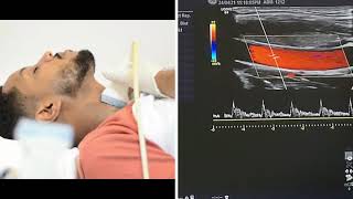 Carotid and Vertebral Arteries Doppler Ultrasound Protocols [upl. by Daria756]