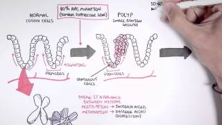 Colon Cancer Carcinogenesis [upl. by Artinak446]