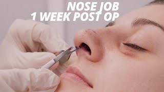 Rhinoplasty Vlog Part 2  Splint Removal and Nose Job Recovery 1 WEEK POST OP [upl. by Koblas]