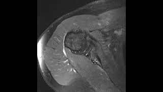 Glenoid hypoplasia and posterior labral tear [upl. by Wenz]