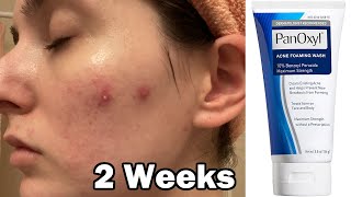 I tried panoxyl face wash for 2 weeks to clear my acne [upl. by Aneehsit]