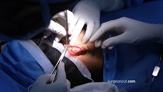 Ear Pinning Otoplasty for a Man  Complete Surgery [upl. by Nyliret840]