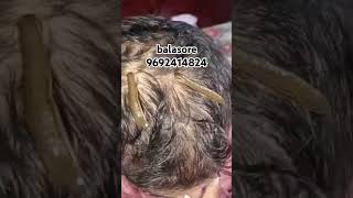 Leech therapy for hair growth 9692414824 beauty balasore odisha [upl. by Stockton364]