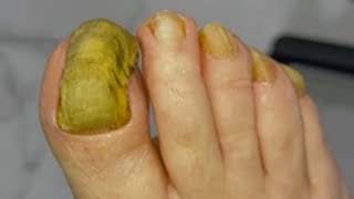 Huge ingrown toenail fungus treatment  Best video good healthy 01 [upl. by Peednam]