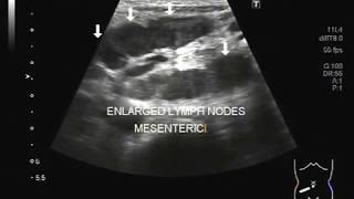 Ultrasound Video showing bilateral enlargement of mesenteric lymph nodes in a Pt aged 10 years [upl. by Ennad327]