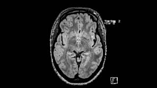 White matter disease associated with migraine headaches [upl. by Okomot]