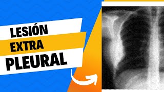 Lesión extrapleural radiografía de tórax [upl. by Aizatsana103]