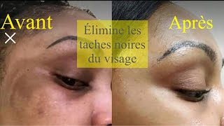 Comment se débarrasser des taches noires du visage rapidement [upl. by Leerzej793]