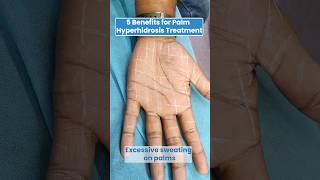 Palm Hyperhidrosis Treatment  5 Benefits of Palm Hyperhidrosis Treatment [upl. by Leiruh]