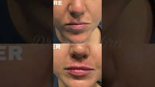 Before and after lip filler at Beverly Hills Wellness Center amp Med Spa Florida shorts [upl. by Monia]