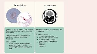 Non thrombotic embolism [upl. by Avram]