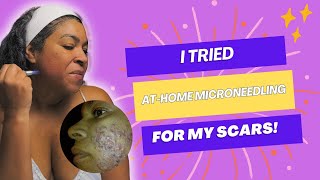 How to Microneedling at Home Safey for Ace Scars microneedling acnescars skincare agingskin [upl. by Alraep]