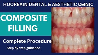 composite filling beauty dentalbeauty smiledental [upl. by Letrice]