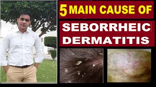 5 Main Causes Of Seborrheic Dermatitis  Hair Loss  सेबोररहेक डर्मेटाइटिस और बालो का झड़ना [upl. by Raquela]