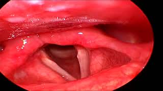 Granular Pharyngitis with Oedematous Arytenoids [upl. by Doss]