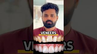 Dental Stories 12  Always use metal free crowns  dentalife malayalam toothcrown smilecare [upl. by Giesser]