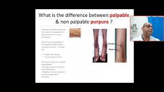 Whats the difference between palpable amp non palpable purpura platelet coagulation vascular cause [upl. by Brigit722]