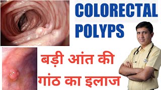 Colorectal Polyps  Symptoms Causes amp Medicine  Polyps in Hindi  Polyps Treatment in Homeopathy [upl. by Brandie]