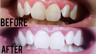 Review iSmile Teeth Whitening Kit  Amazon Finds [upl. by Hotchkiss401]