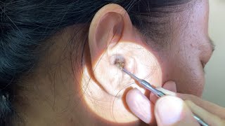 Massive Hard Dry Earwax Removed from Womans Ear [upl. by Nniroc]