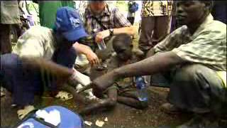 Voices from the Field Guinea Worm Eradication [upl. by Swope]