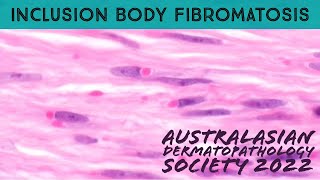 Inclusion Body Fibromatosis Infantile Digital Fibromatosis in 5 Minutes dermpath pathology [upl. by Nason849]