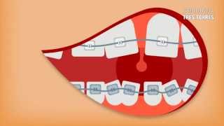 Porque ha cambiado la ortodoncia [upl. by Jemmy]