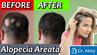 Alopecia Areata Causes and Treatment from a Dermatologist [upl. by Weissman23]