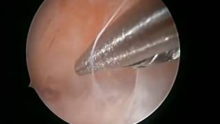 Miracles of Hysteroscopy Asherman adhesions from zero to hero [upl. by Delfine]