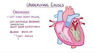 Pulmonary Edema causes symptoms diagnosis treatment pathology [upl. by Murdocca456]