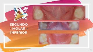 Primer y Segundo Molar Inferior de la Dentición Temporal Interactivo [upl. by Adna650]