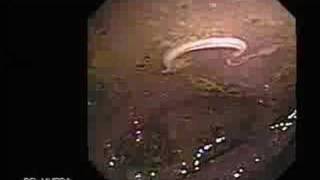 Video Colonoscopy Showing a Parasite in the Cecum [upl. by Pilar]