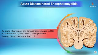 Acute disseminated encephalomyelitis  Neurology [upl. by Sarat]