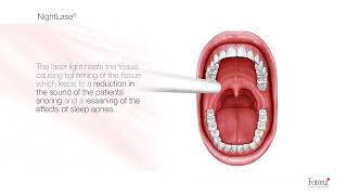 Snoring and Sleep Apnea Treatment with NightLase® [upl. by Johnston]